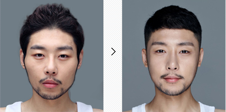 ศัลยกรรมลดโหนกแก้ม