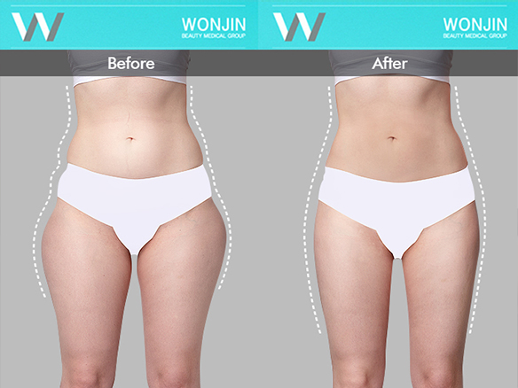 body-contour-before-and-after-01