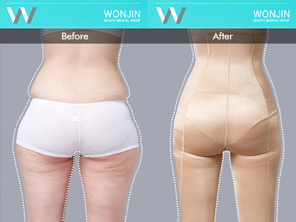 body-contour-before-and-after-02