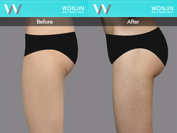 body-contour-before-and-after-03