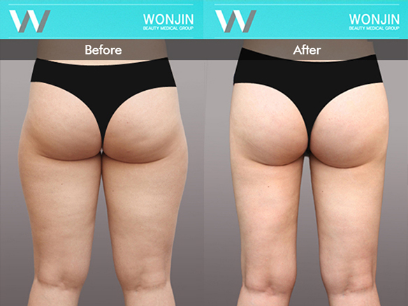 body-contour-before-and-after-04