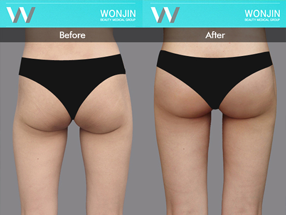 body-contour-before-and-after-05