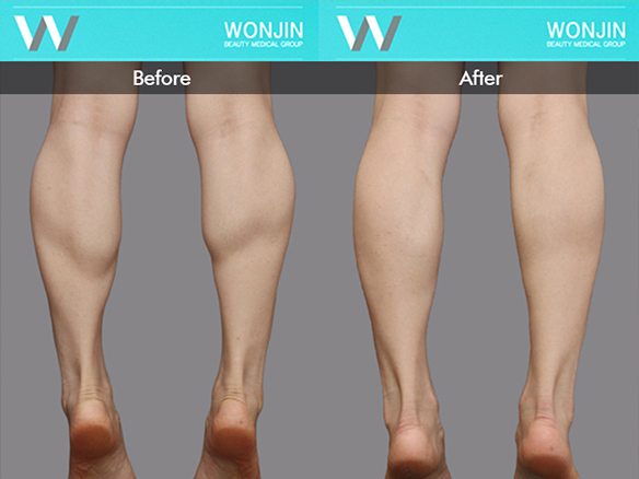 body-contour-before-and-after-06