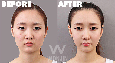 ศัลยกรรมหน้าเรียว