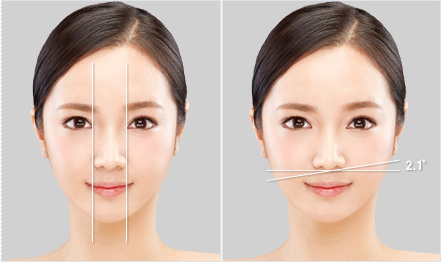 ตัดปีกจมูก