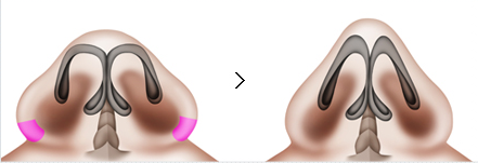 ตัดปีกจมูก