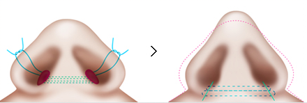 ตัดปีกจมูก