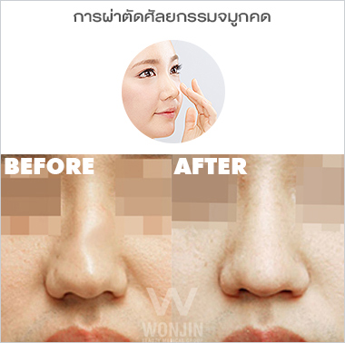 ศัลยกรรมจมูก