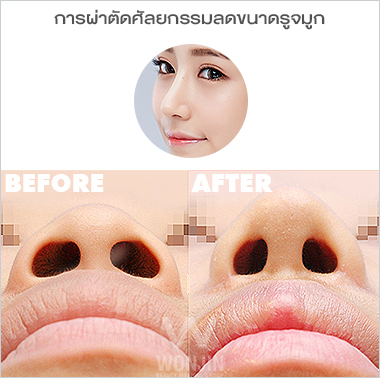 ศัลยกรรมจมูก