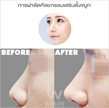 ศัลยกรรมจมูก