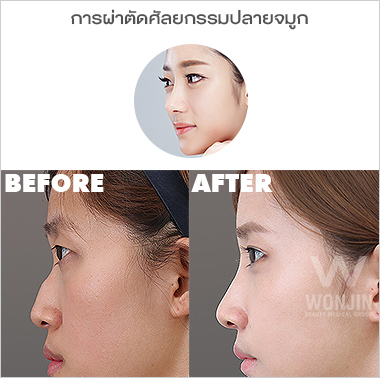 ศัลยกรรมจมูก