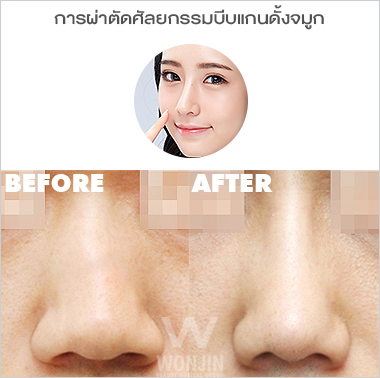 ศัลยกรรมจมูก