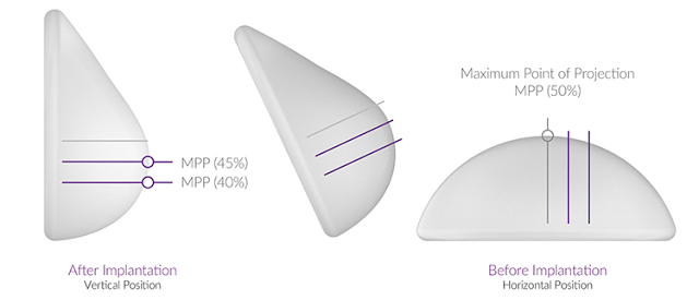 เสริมหน้าอก ทำนม