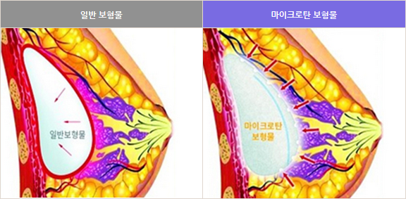 เสริมหน้าอก ทำนม