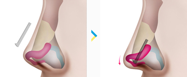 การใส่ซิลิโคนจมูก