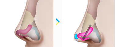 เสริมซิลิโคนจมูก