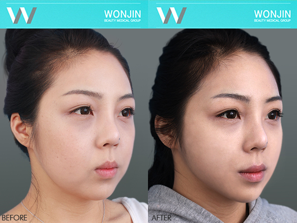 ฟิลเลอร์คาง