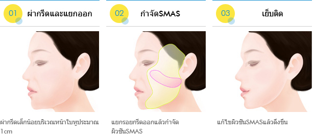 การดึงหน้า