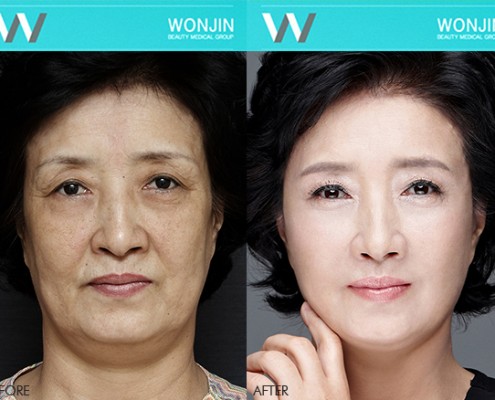 ดึงหน้า