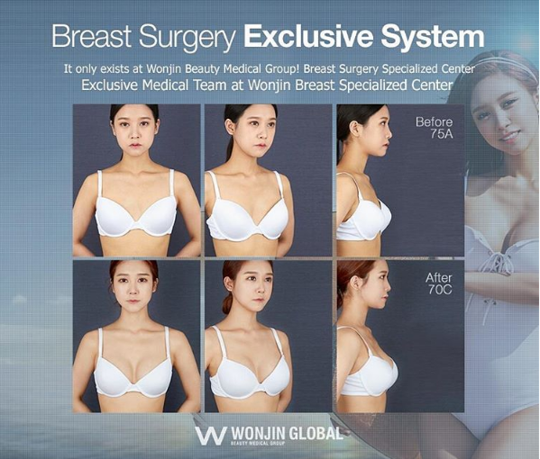 ศัลยกรรมหน้าอก