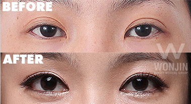 ศัลยกรรมตา6