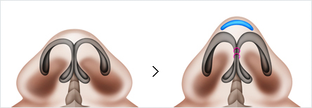 02_코끝을 높여야 하는 경우