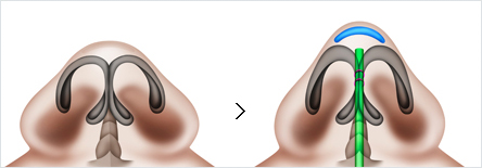 03_코 끝을 강하게 지지해야 하는 경우