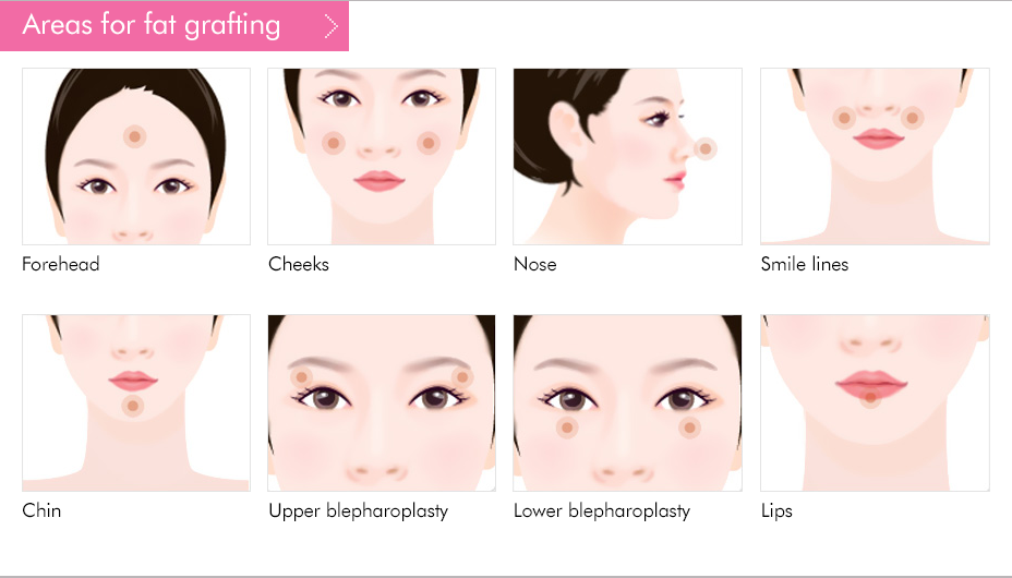 ฉีดไขมัน