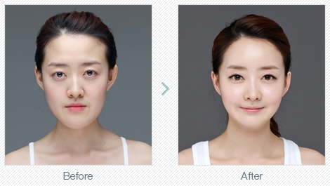 ศัลยกรรมหน้าเรียว