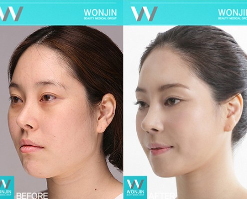 การปรับรูปหน้า