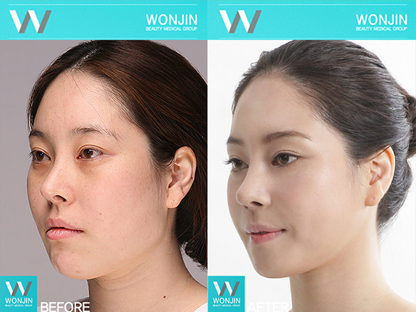 การปรับรูปหน้า