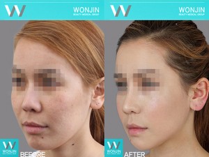 face-contour-in_korea_befor-and-after-05