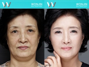 thread_lift_befor-and-after-03