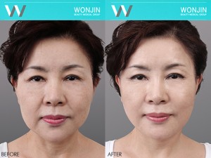 thread_lift_befor-and-after-04