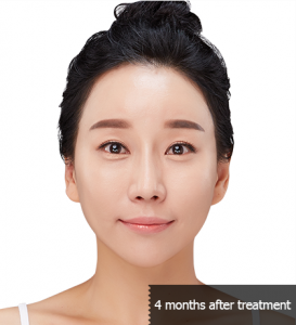 การร้อยไหมที่ไหนดี