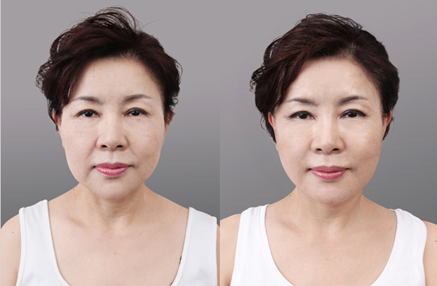 ร้อยไหม