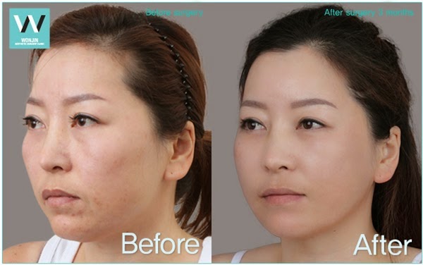 ร้อยไหมที่ไหนดี