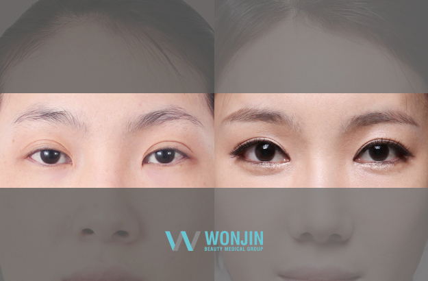 ตาไม่เท่ากัน