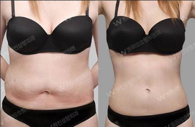 ดูดไขมันก่อนและหลังที่วอนจิน