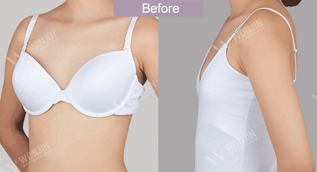 เสริมหน้าอก