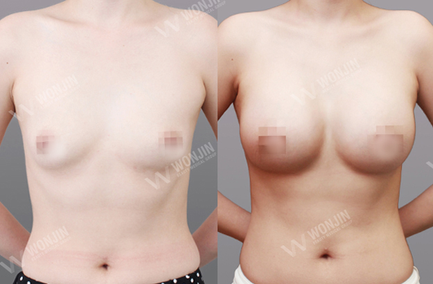 เสริมหน้าอก