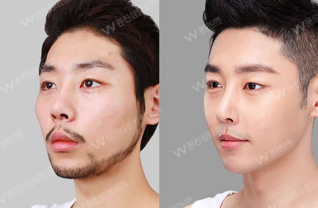 ศัลยกรรมผูชาย