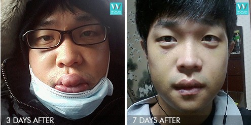 รีวิวศัลยกรรมผู้ชาย