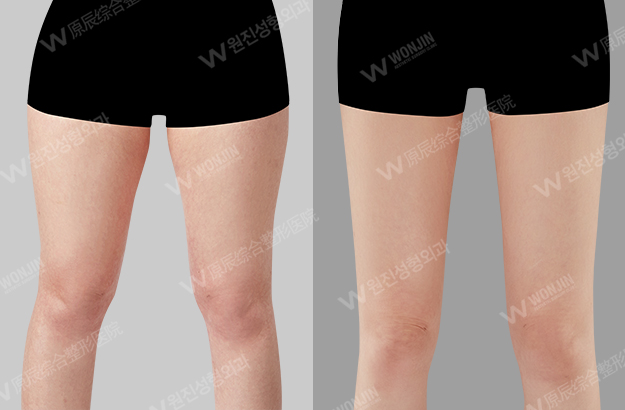 ดูดไขมันไม่เป็นคลื่น