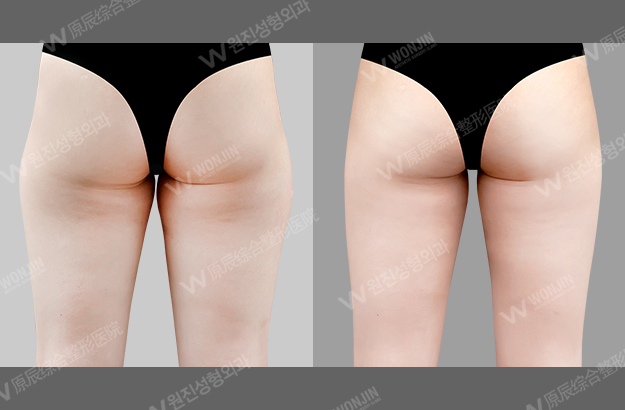 ดูดไขมันที่เกาหลี