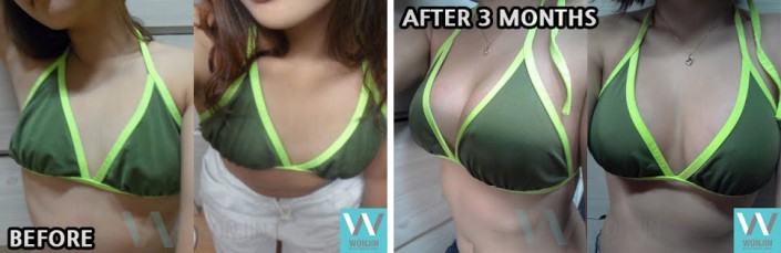 รีวิวทำหน้าอกก่อน-หลัง