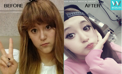 รีวิวศัลยกรรมขากรรไกร