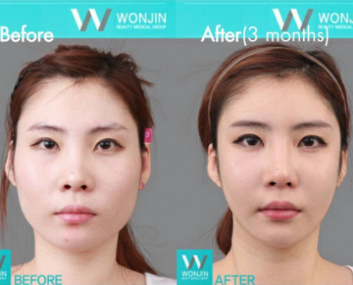 ฉีดโบท๊อก หน้าเรียว