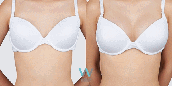 เสริมหน้าอก ทำนม