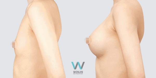 เสริมหน้าอก ทำนม